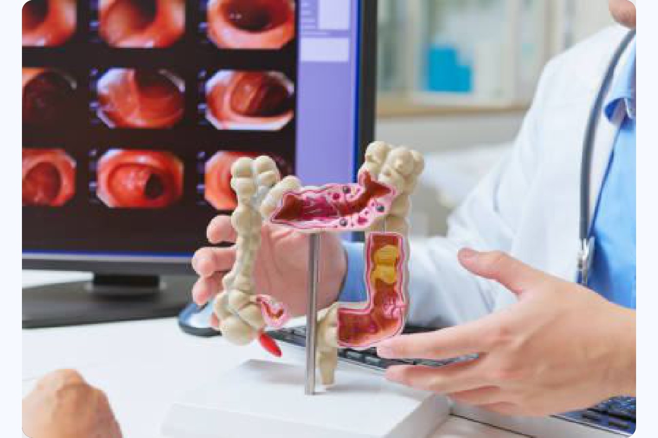 Factores de riesgo del cáncer de colon
